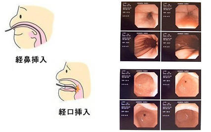 経鼻内視鏡検査